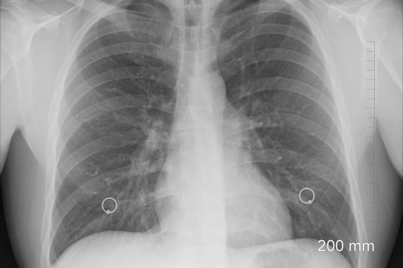 xray-poumons-côtes-thoraciques